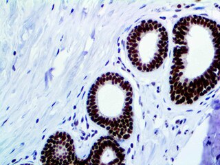 IHC of FOXP1 on an FFPE Breast Tissue
